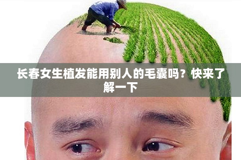 长春女生植发能用别人的毛囊吗？快来了解一下