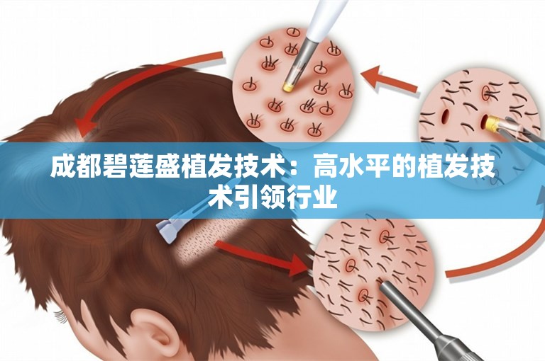 成都碧莲盛植发技术：高水平的植发技术引领行业