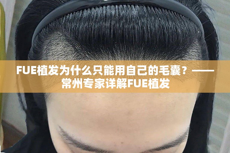 FUE植发为什么只能用自己的毛囊？——常州专家详解FUE植发