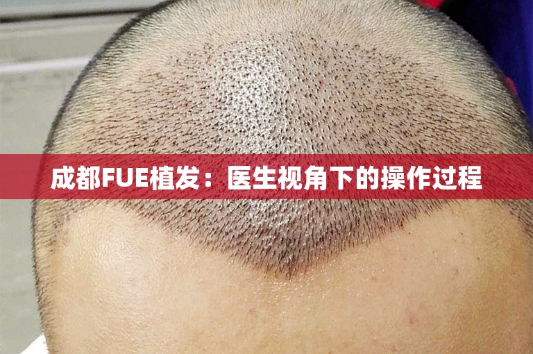 成都FUE植发：医生视角下的操作过程