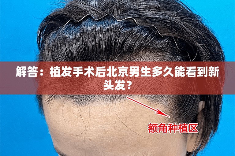 解答：植发手术后北京男生多久能看到新头发？