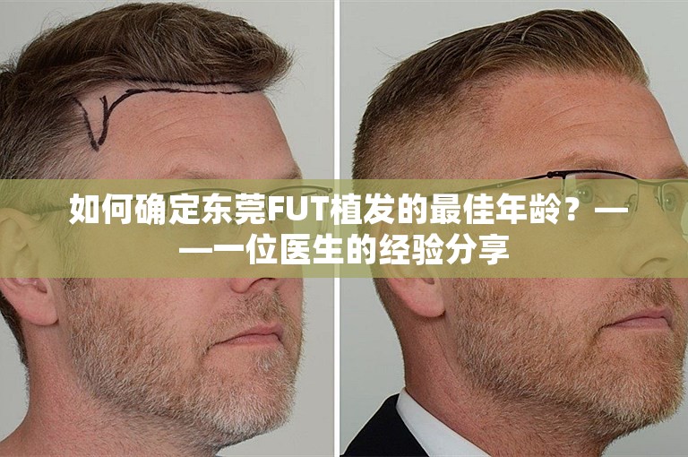  如何确定东莞FUT植发的最佳年龄？——一位医生的经验分享