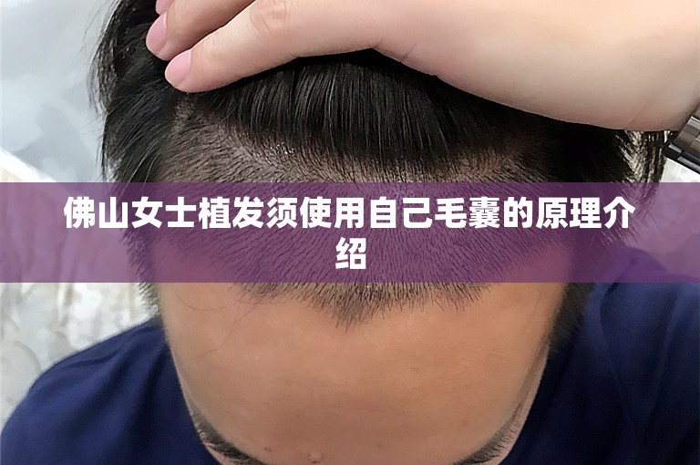 佛山女士植发须使用自己毛囊的原理介绍