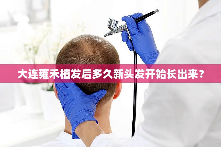 大连雍禾植发后多久新头发开始长出来？