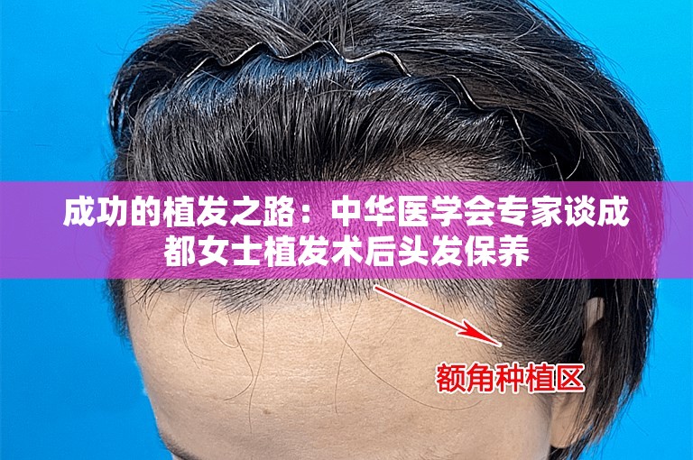 成功的植发之路：中华医学会专家谈成都女士植发术后头发保养