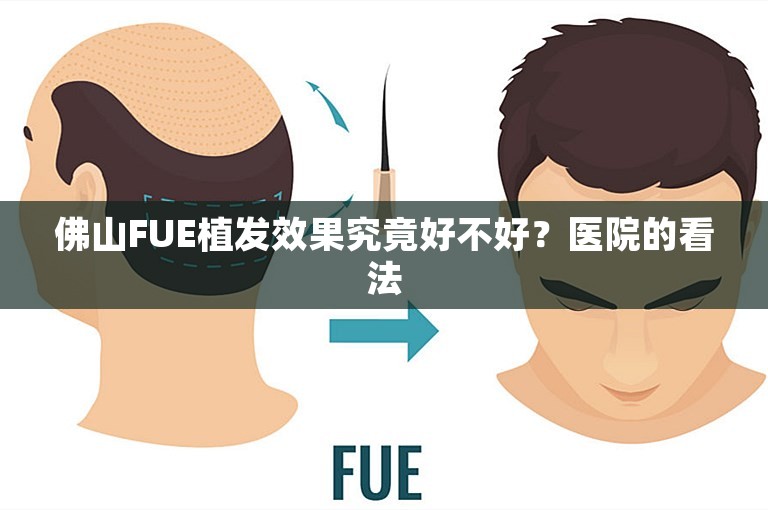 佛山FUE植发效果究竟好不好？医院的看法