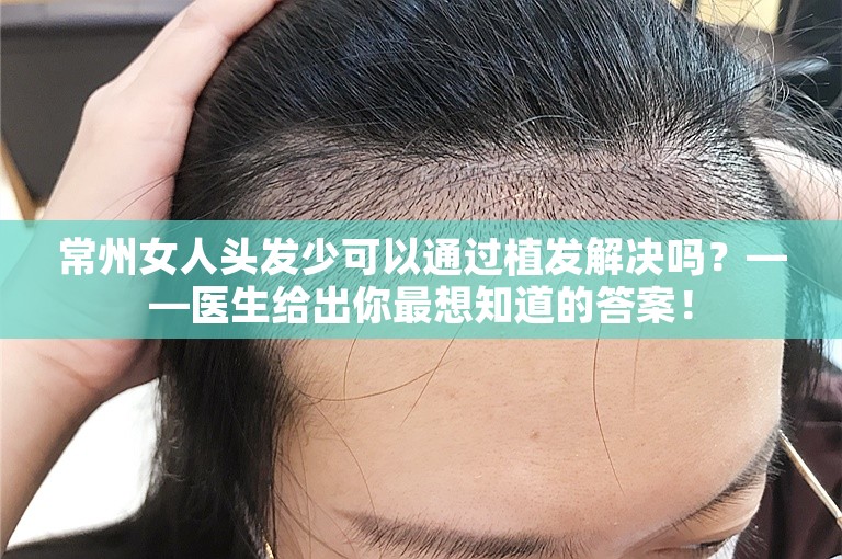 常州女人头发少可以通过植发解决吗？——医生给出你最想知道的答案！