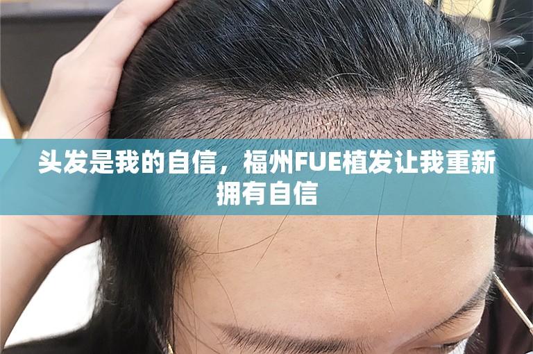 头发是我的自信，福州FUE植发让我重新拥有自信