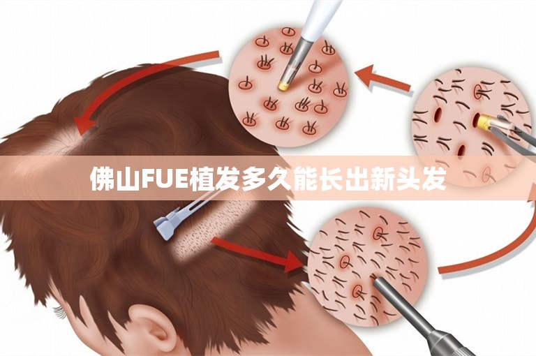 佛山FUE植发多久能长出新头发