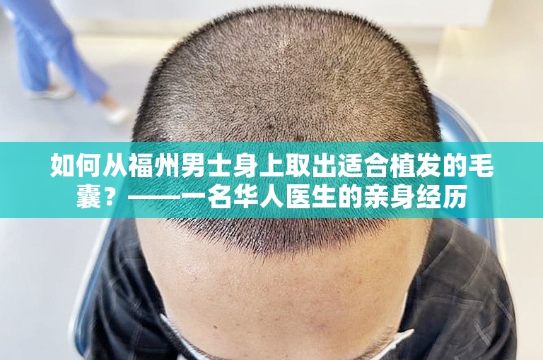 如何从福州男士身上取出适合植发的毛囊？——一名华人医生的亲身经历