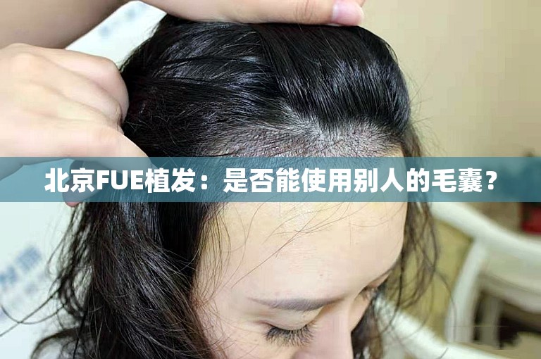 北京FUE植发：是否能使用别人的毛囊？