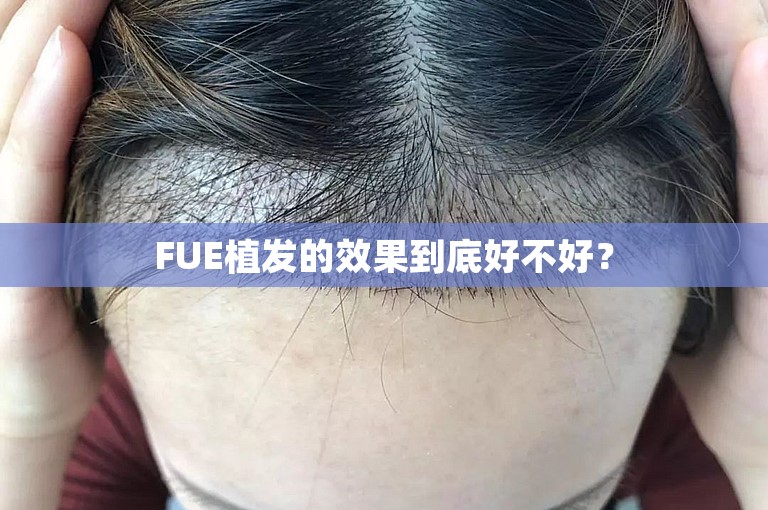 FUE植发的效果到底好不好？