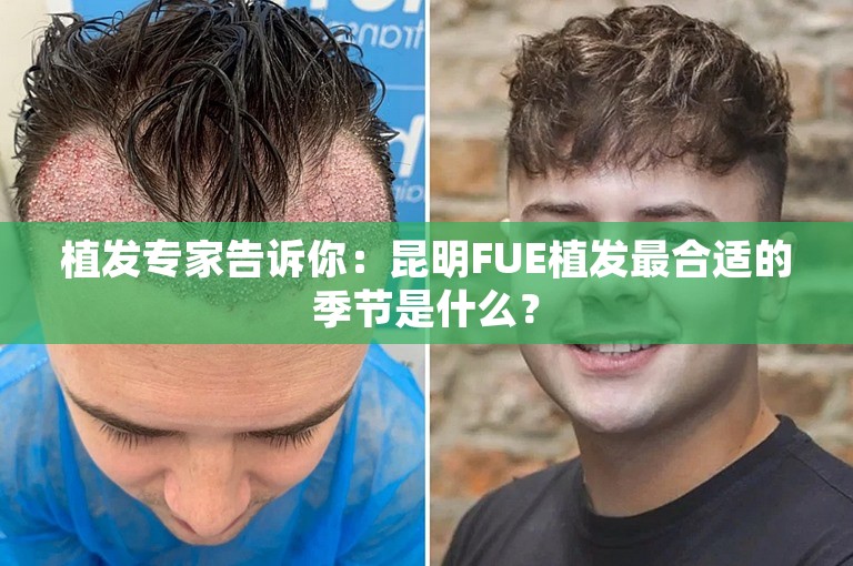 植发专家告诉你：昆明FUE植发最合适的季节是什么？