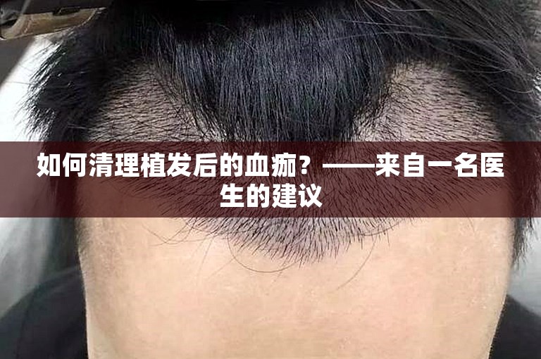 如何清理植发后的血痂？——来自一名医生的建议