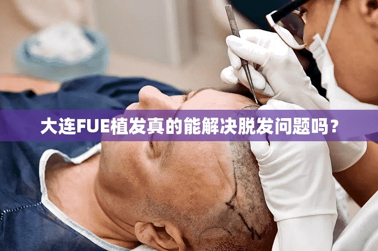 大连FUE植发真的能解决脱发问题吗？