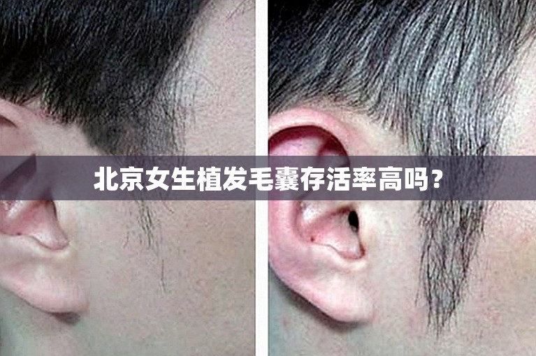 北京女生植发毛囊存活率高吗？