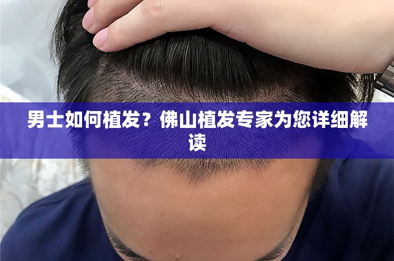 男士如何植发？佛山植发专家为您详细解读