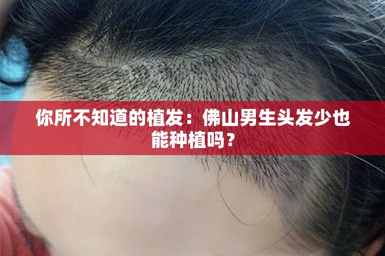 你所不知道的植发：佛山男生头发少也能种植吗？