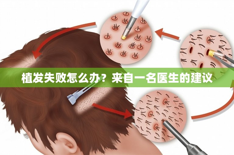 植发失败怎么办？来自一名医生的建议