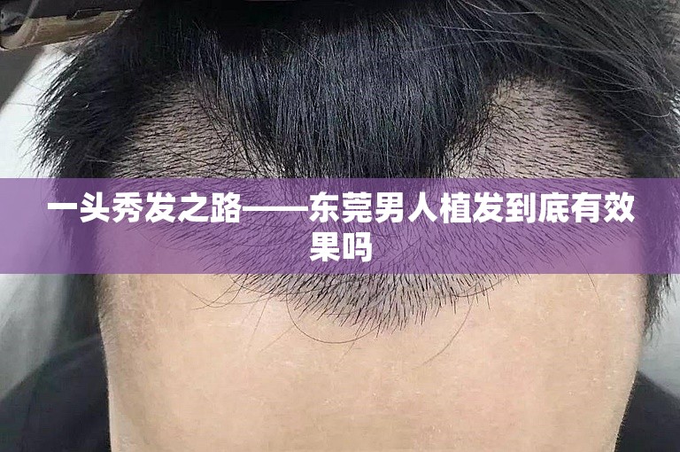 一头秀发之路——东莞男人植发到底有效果吗