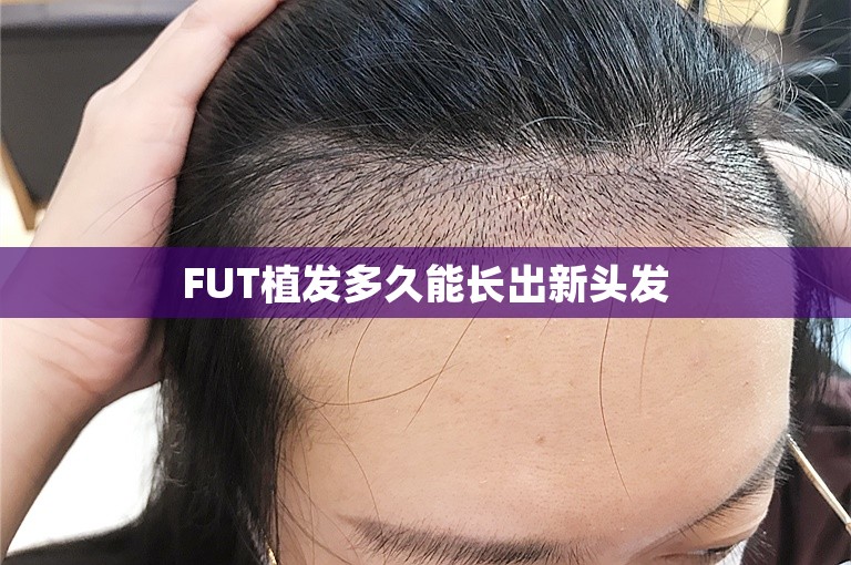 FUT植发多久能长出新头发