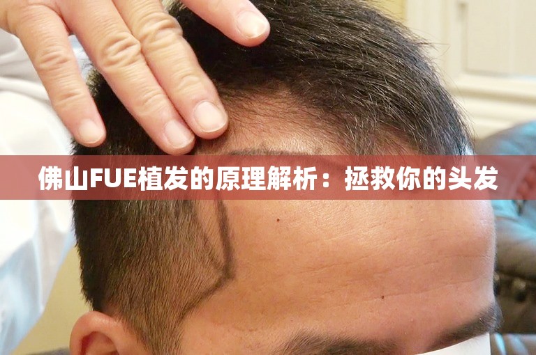 佛山FUE植发的原理解析：拯救你的头发