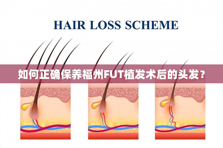 如何正确保养福州FUT植发术后的头发？