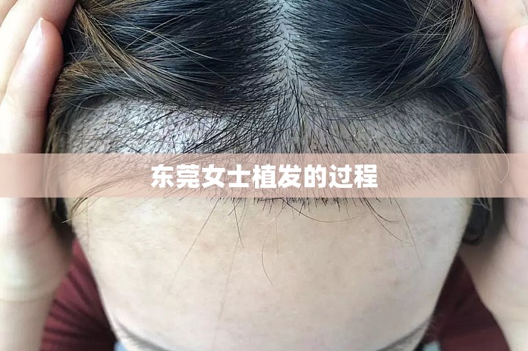 东莞女士植发的过程