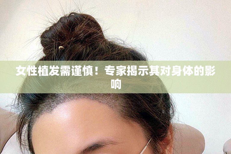 女性植发需谨慎！专家揭示其对身体的影响