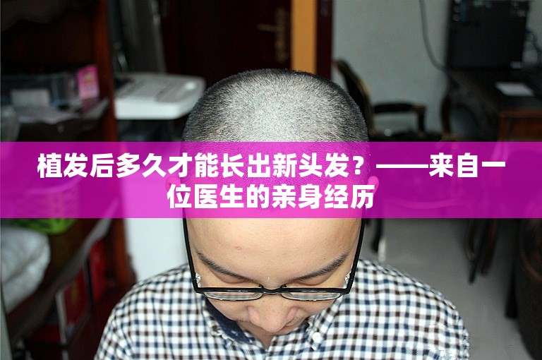 植发后多久才能长出新头发？——来自一位医生的亲身经历