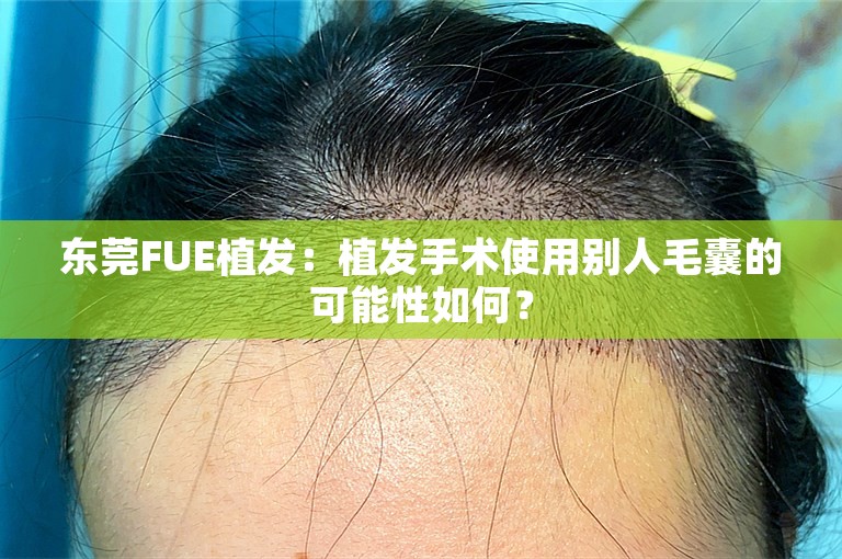 东莞FUE植发：植发手术使用别人毛囊的可能性如何？