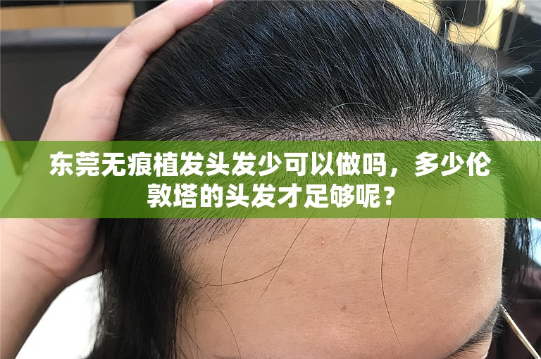 东莞无痕植发头发少可以做吗，多少伦敦塔的头发才足够呢？