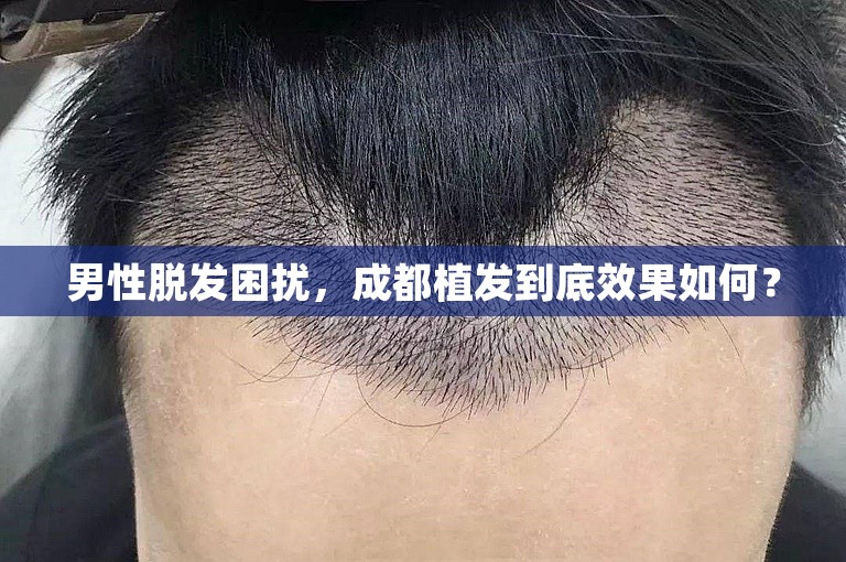 男性脱发困扰，成都植发到底效果如何？