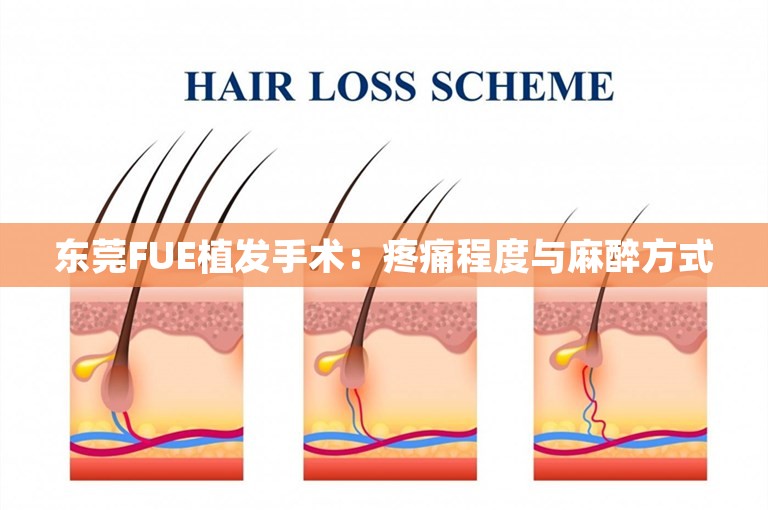 东莞FUE植发手术：疼痛程度与麻醉方式