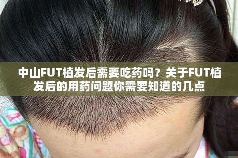 中山FUT植发后需要吃药吗？关于FUT植发后的用药问题你需要知道的几点