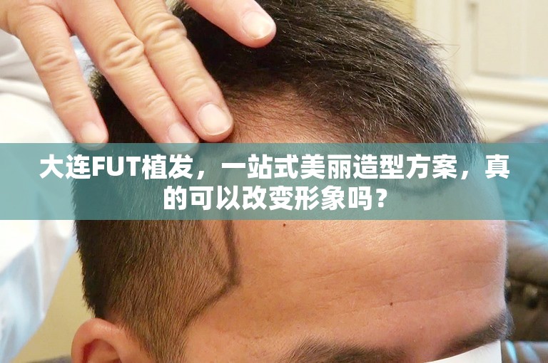 大连FUT植发，一站式美丽造型方案，真的可以改变形象吗？