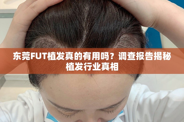 东莞FUT植发真的有用吗？调查报告揭秘植发行业真相