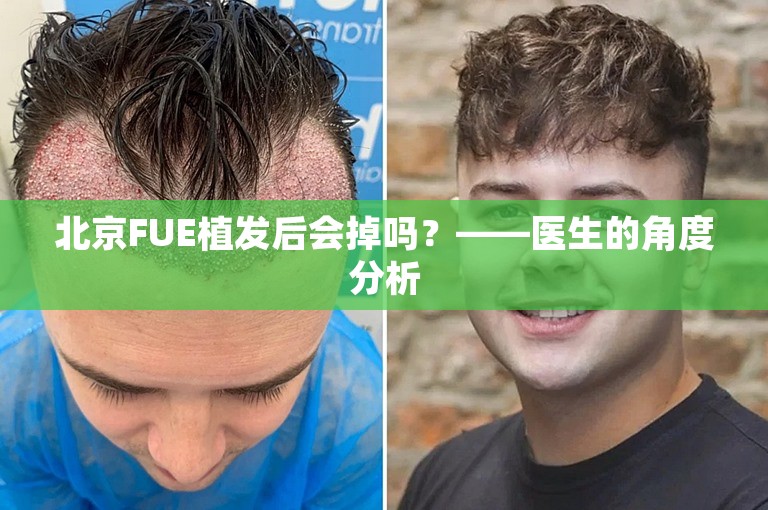 北京FUE植发后会掉吗？——医生的角度分析