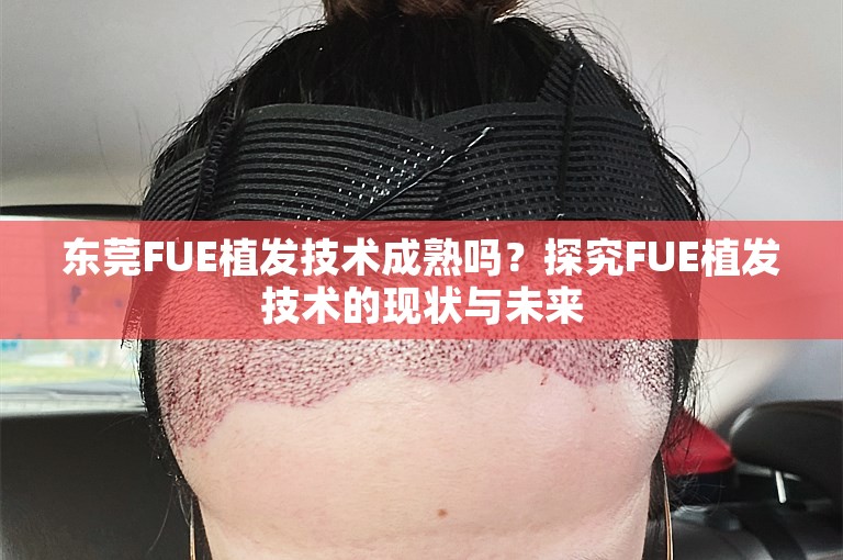 东莞FUE植发技术成熟吗？探究FUE植发技术的现状与未来