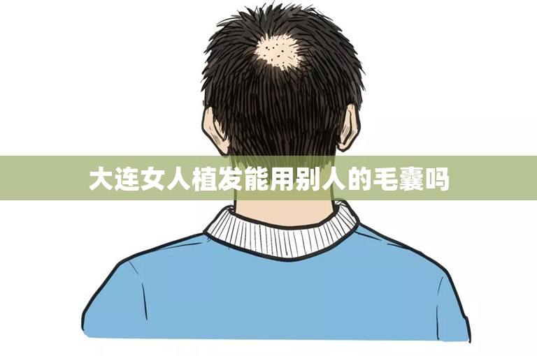 大连女人植发能用别人的毛囊吗