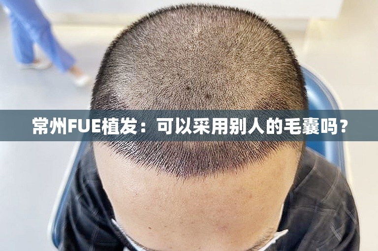 常州FUE植发：可以采用别人的毛囊吗？