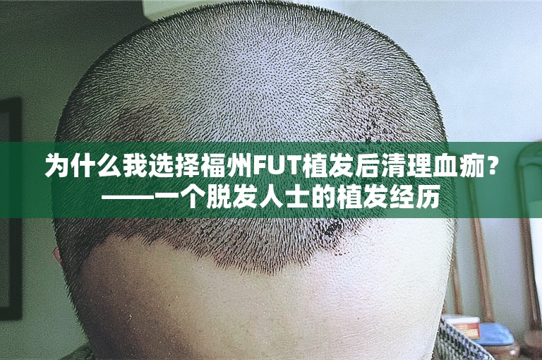 为什么我选择福州FUT植发后清理血痂？——一个脱发人士的植发经历