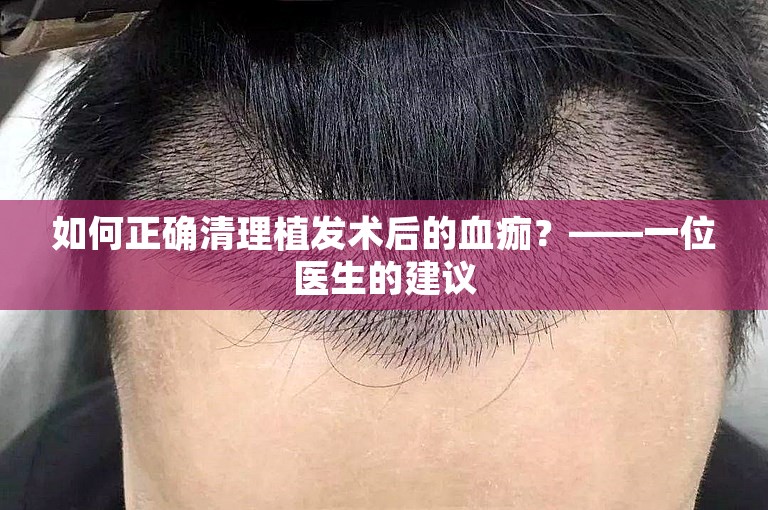 如何正确清理植发术后的血痂？——一位医生的建议