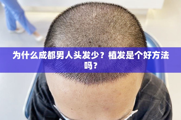 为什么成都男人头发少？植发是个好方法吗？