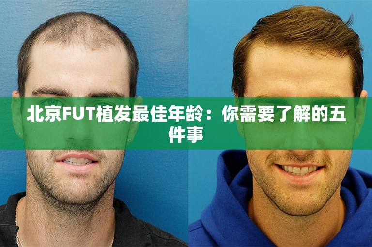 北京FUT植发最佳年龄：你需要了解的五件事