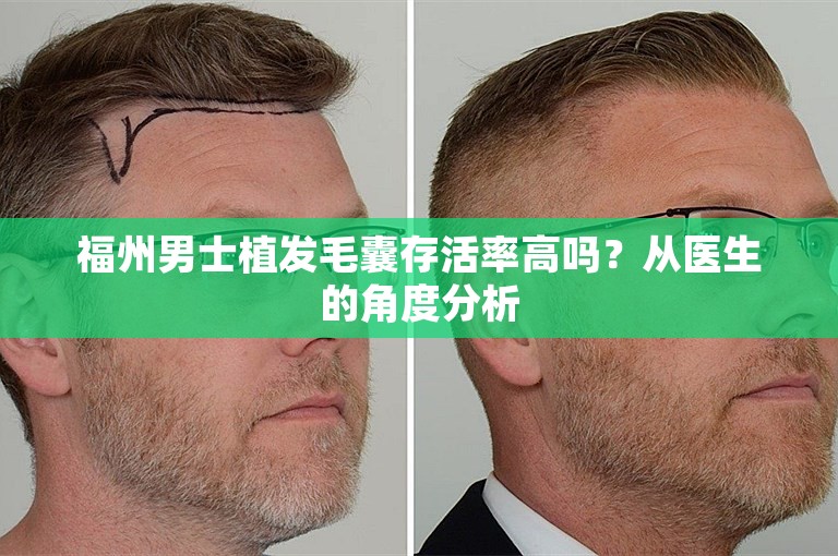 福州男士植发毛囊存活率高吗？从医生的角度分析