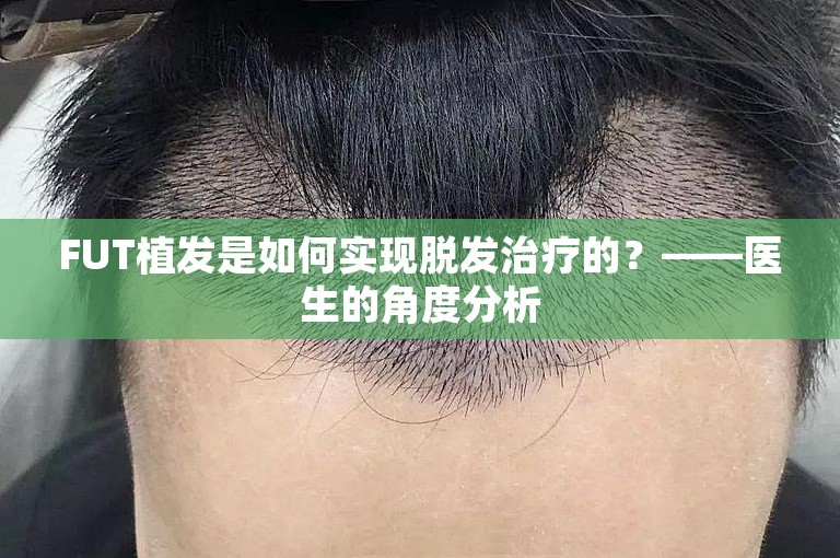 FUT植发是如何实现脱发治疗的？——医生的角度分析