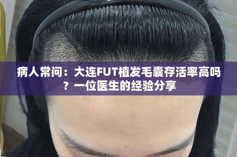 病人常问：大连FUT植发毛囊存活率高吗？一位医生的经验分享