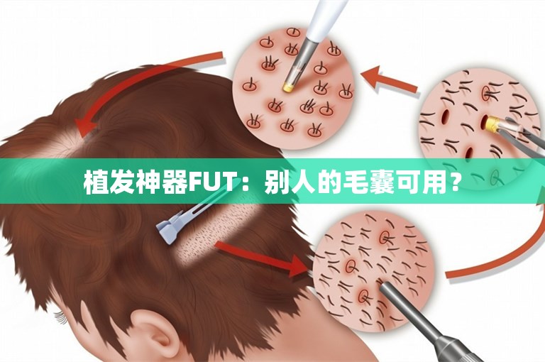 植发神器FUT：别人的毛囊可用？