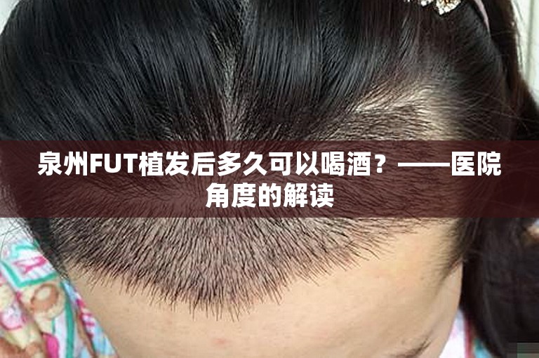 泉州FUT植发后多久可以喝酒？——医院角度的解读